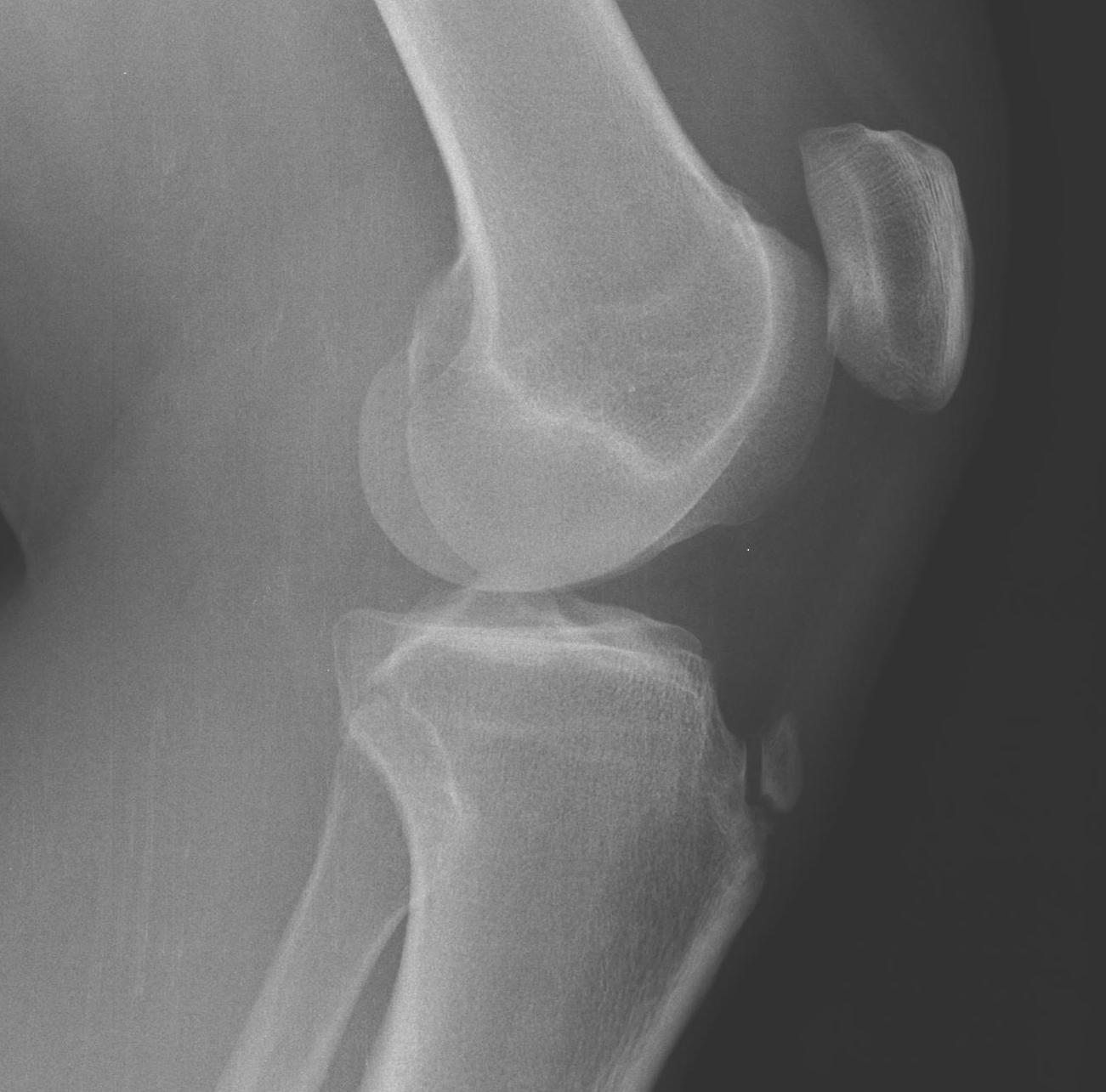 Osgood Schlatter's